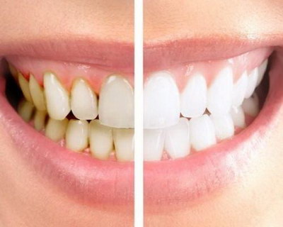 带牙套会对牙齿有什么伤害