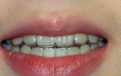 补牙是什么材质的对孕妇有影响吗