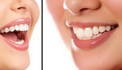 牙齿侧面龋齿怎么治