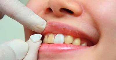 怎么看上排牙齿有没有蛀牙_只戴上排牙齿牙套可以吗
