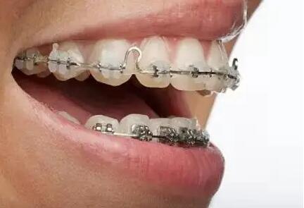 牙套如何佩戴_拆牙套全过程