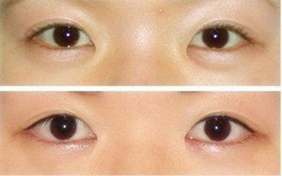 做双眼皮多久才能完全恢复_做双眼皮副作用大吗
