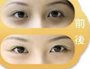 韩式双眼皮的效果_韩式双眼皮能保持多久?