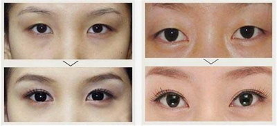 三点定位双眼皮手术过程_三点定位双眼皮手术