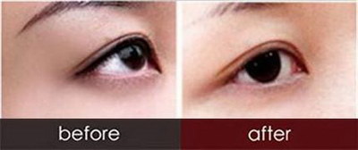 什么样的双眼皮类型最好看_双眼皮一般多久恢复完全消肿