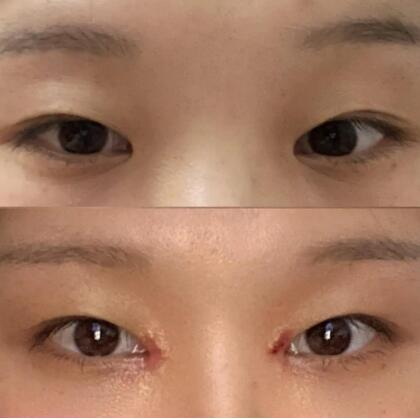 做眼睛近视手术要多久(手术前的预处理需要多长时间？)