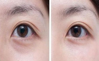 眼睛下面出现细纹怎么去除青光眼_眼睛斜视如何治疗青光眼
