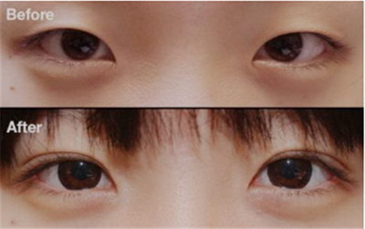 眼角上眼皮有一小红点怎么回事_左眼上眼皮持续肿一个月