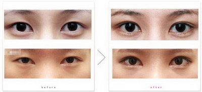 日式雷点双眼皮是什么_日式订书机双眼皮多久恢复