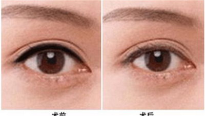 长期贴双眼皮贴会造成什么问题(长期使用双眼皮贴的危害与隐患)