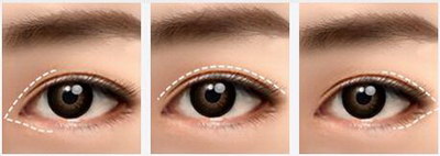 韩式焊接双眼皮和埋线的区别(生物焊接双眼皮和埋线的区别)