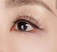 韩式三点双眼皮能保持几年(韩式三点双眼皮的原理和特点)