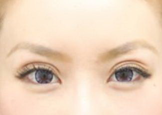 双眼皮早期修复有影响吗