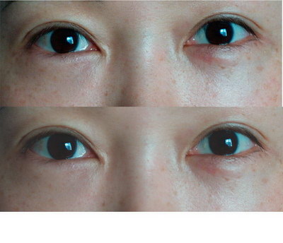 有弧度的双眼皮贴_韩式双眼皮贴法教程