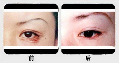 眼窝双眼皮手术后什么时候开始增生结疤