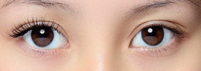 全切平行双眼皮和开眼角:谨慎选择美容手术(全切平行双眼皮开眼角提肌7.5毫米)