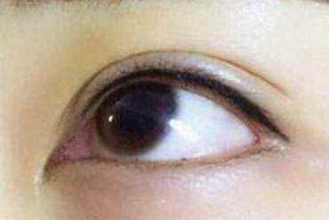 婴儿单眼皮变双眼皮过程_双眼皮与单眼皮的遗传性