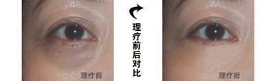 眼睛怎么变成双眼皮自然方法(如何通过天然方法让单眼皮变双眼皮?)