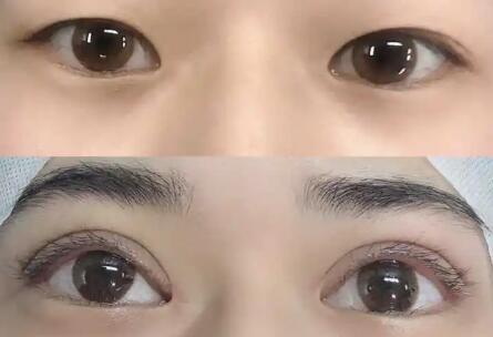 韩式双眼皮手术的价格