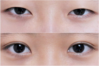 双眼皮变单眼皮是什么原因(单眼皮自然变成双眼皮是什么原因)