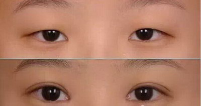 韩国人眼睛小单眼皮(韩国人天生都是单眼皮吗)