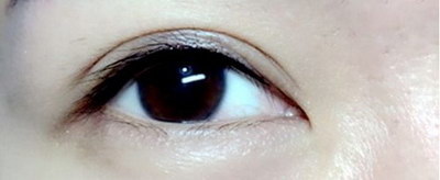 双眼皮为什么变成了好多条眼皮