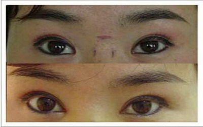 杭州哪家医院的去眼袋手术更可靠?_外切眼袋手术后多久才会没有疤痕
