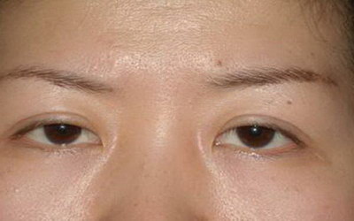 内开眼角的疤多久能恢复(什么是内开眼角手术？)