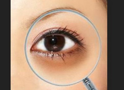 黑眼圈和眼下细纹的诊断_黑眼圈可以彻底消除吗