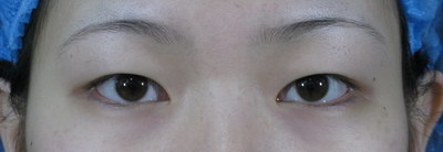 在徐州做双眼皮--选择权威专业医院和细心技术手术