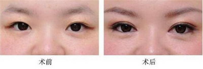 割双眼皮手术一般要多长时间_割双眼皮三个月睁眼紧绷