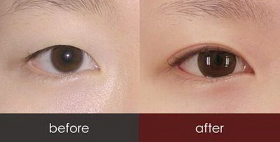 双眼皮手术与喝豆浆:关于安全问题以及护理_双眼皮祛疤膏哪款比较好用