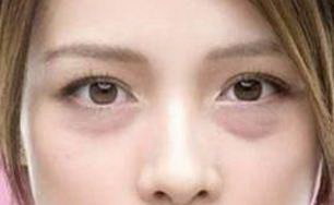 双眼皮失败案例眼睛畸形_眼睛如何变成双眼皮