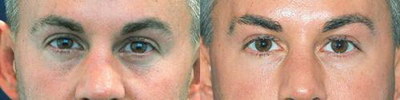 眼睑下垂手术会影响眼睫毛吗