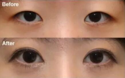 洛阳双眼皮的修复_杭州专业割双眼皮的医院