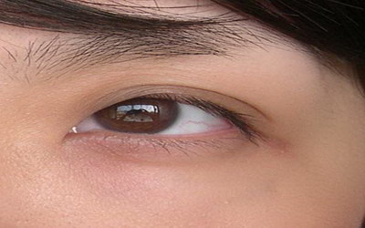 天生上眼皮肿怎么消除常见方法_天生上眼皮浮肿是怎么消除