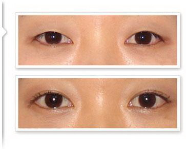 眼睑下垂手术适宜年龄(眼睑下垂手术适宜时间)