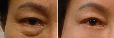 双眼皮术一年后眼皮颜色深多久能恢复