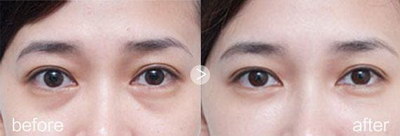 无锡韩式双眼皮：改变你的外貌，让你成为焦点