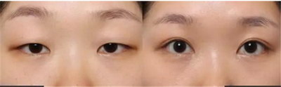 外眼角提升手术过程_外眼角提升手术后多久能恢复