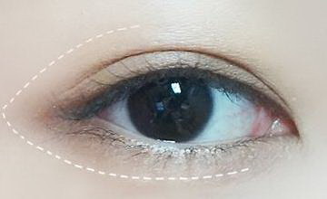 双眼皮用什么appp图_内双拉双眼皮手术