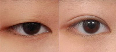 做双眼皮埋线能改善大小眼吗(埋线双眼皮可以改善大小眼吗)