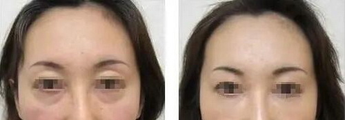 欧式双眼皮手术可以做吗_欧式双眼皮手术恢复过程