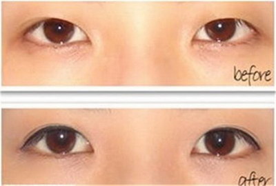 长期的黑眼圈能自行消除吗(长期的黑眼圈能自行消除吗)
