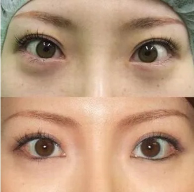 微创双眼皮恢复期不对称_微创双眼皮可以保持多长时间