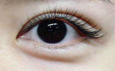 韩式三点双眼皮价格_割三点双眼皮一般价格
