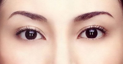 埋线双眼皮多久可以染发_埋线双眼皮半个月的恢复状态