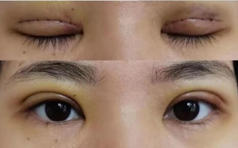 韩式焊接双眼皮和埋线的区别(生物焊接双眼皮和埋线的区别)