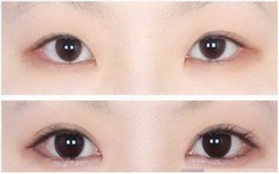 做完双眼皮眼皮上有小白点(双眼皮手术后眼皮上出现小白点是什么原因？)