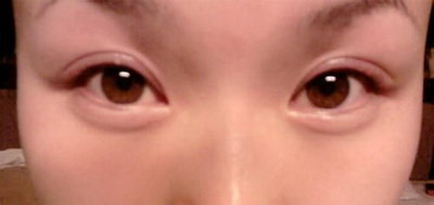 怎么把双眼皮变成三眼皮_杭州哪家医院做的双眼皮好
